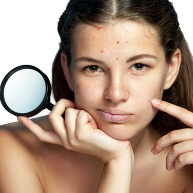 Akne Derma Viso/Corpo